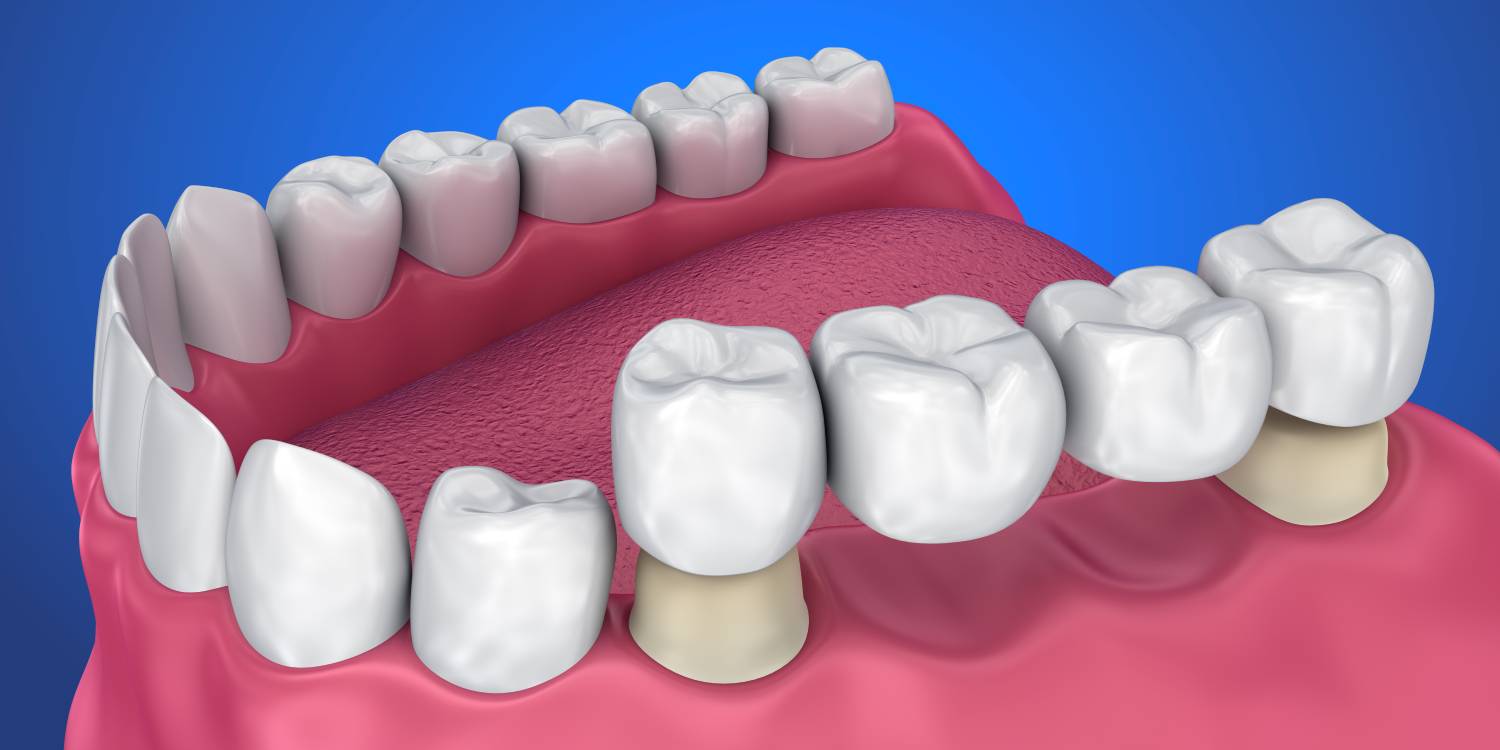 зубной мост на 3 зуба из керамики